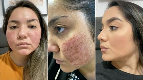Laser Fotona No Rosto Antes E Depois