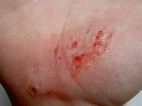 File:Abrasion on hand 20050906.jpg - Wikimedia Commons