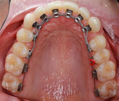 Braces San Diego at Julius Scudder blog