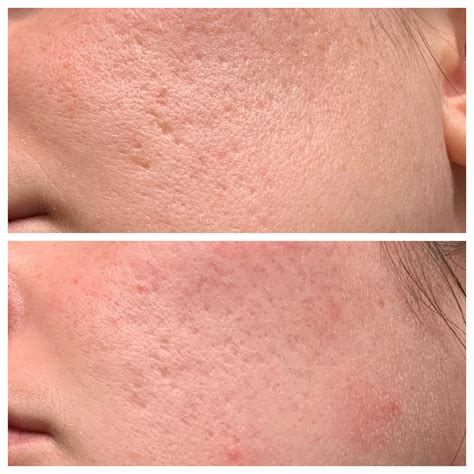 Update! Two months progress on 0.025 for acne scars : r/tretinoin