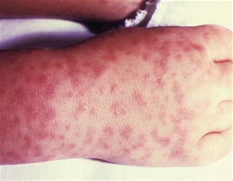 rashes  fever  children sorting   potentially dangerous