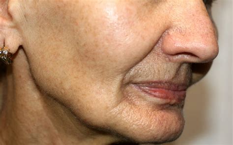 nasolabial fold dr william davis