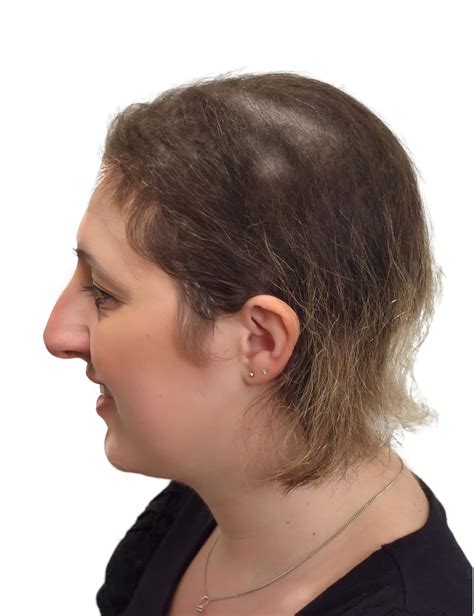 HL103 - Chemotherapy Hair Loss Turnaround - Kinsey System - Before